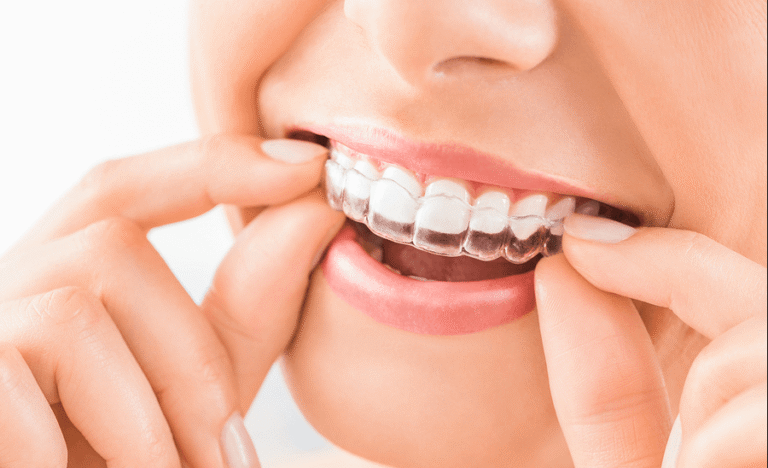 Invisalign: Redefining Adult Orthodontics with Unmatched Comfort
